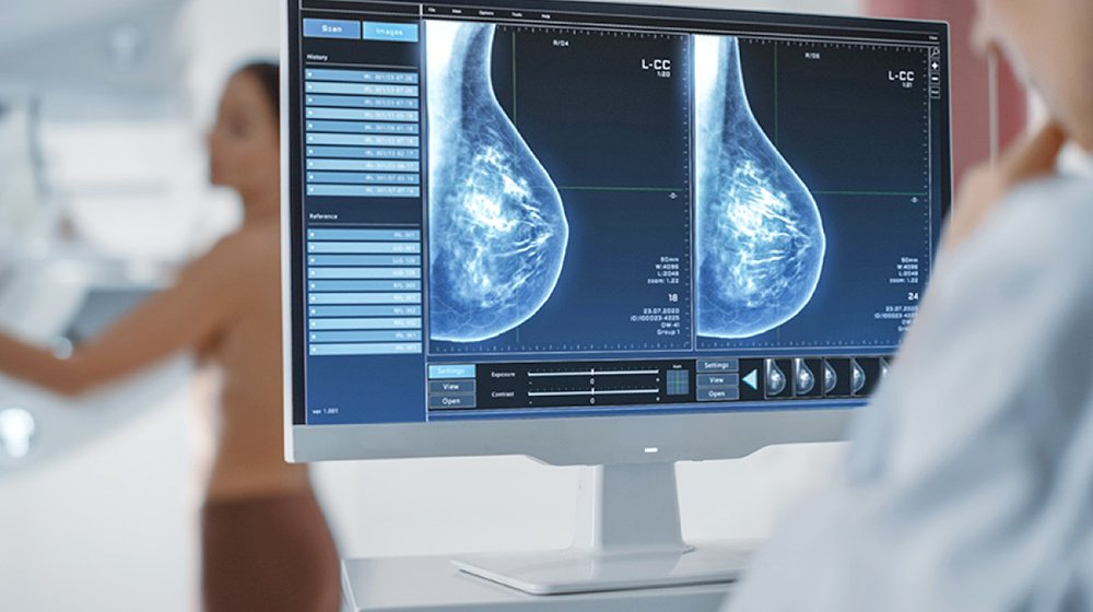 Prueban en Chile algoritmo que permitiría predecir riesgo de cáncer de mamas a través de mamografías